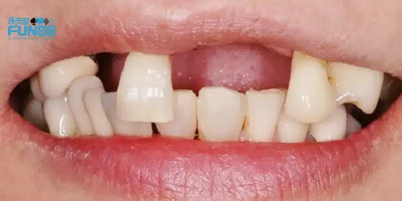 Nằm mơ thấy một chiếc răng rụng